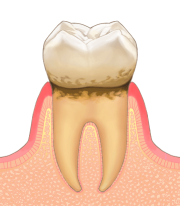 歯周炎のイメージ