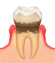 軽度歯周病のイメージ