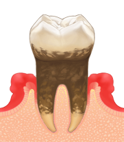 中等度歯周病のイメージ