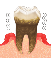 重度歯周病のイメージ