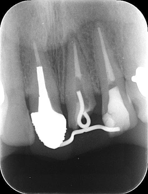 歯が引き上げられたレントゲン写真