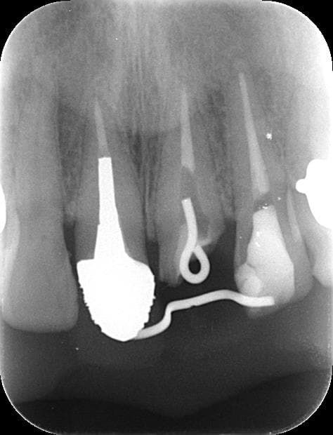 歯を引き上げる前のレントゲン写真