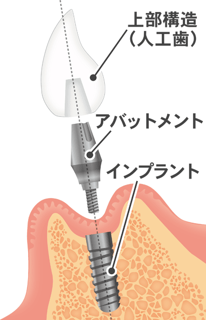 インプラントの構成図