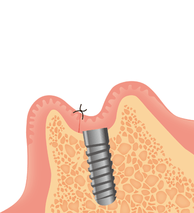 インプラント挿入の図